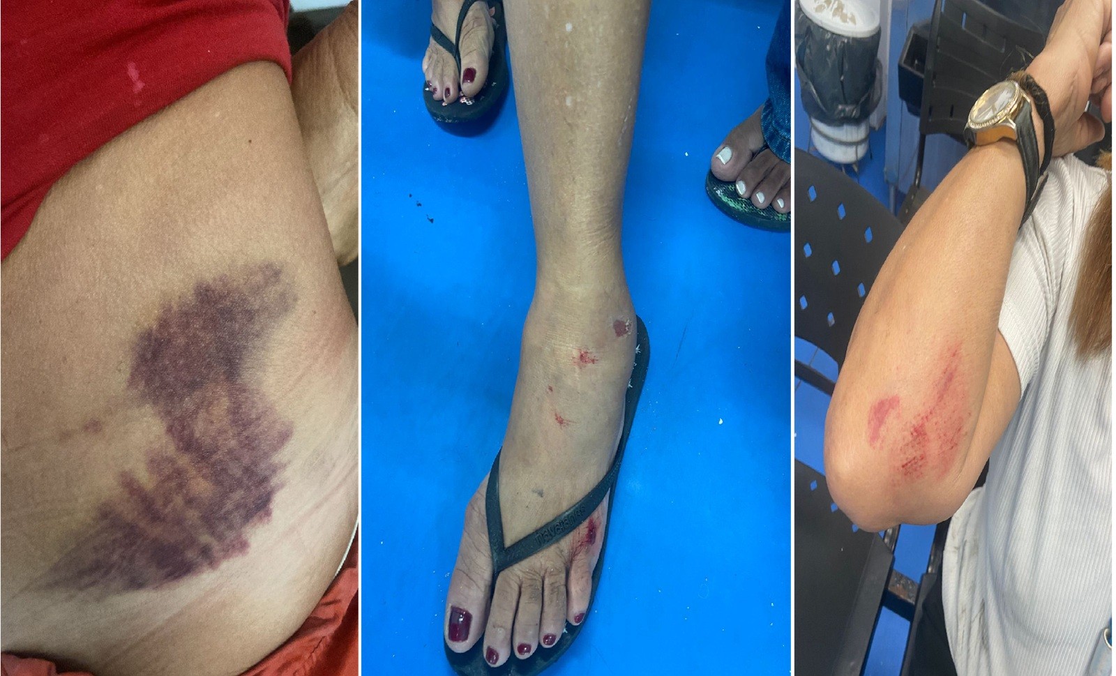 Moradora fica com feridas e hematomas após cair em buraco em Unamar