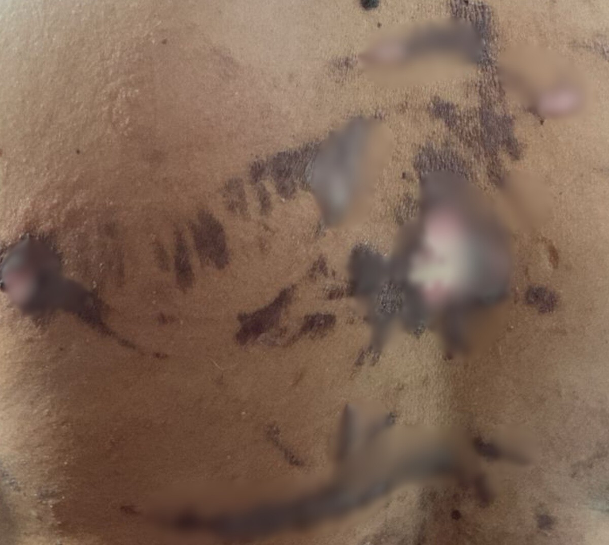 Paciente diz ter ficado sem apoio da prefeitura após queimaduras